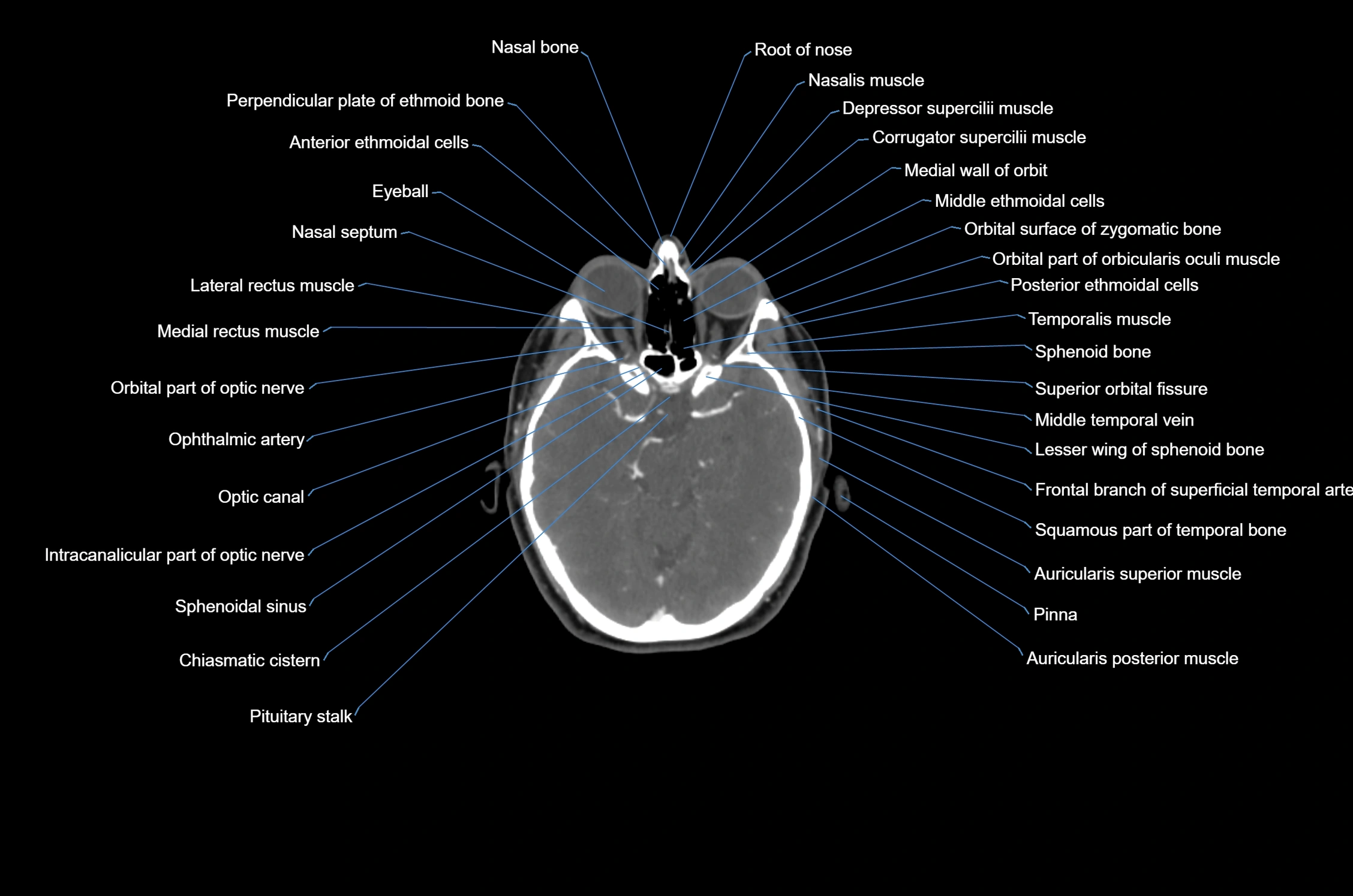 CT Neck axial cross sectional anatomy radiology image-img-00001-00006.webp